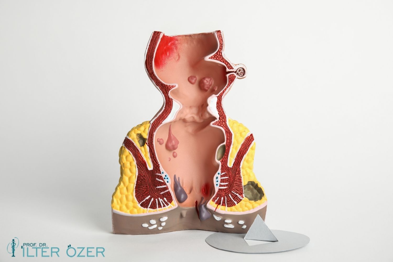 Hemoroid (Basur) Nedir? Neden Olur? Basura Ne İyi Gelir?
