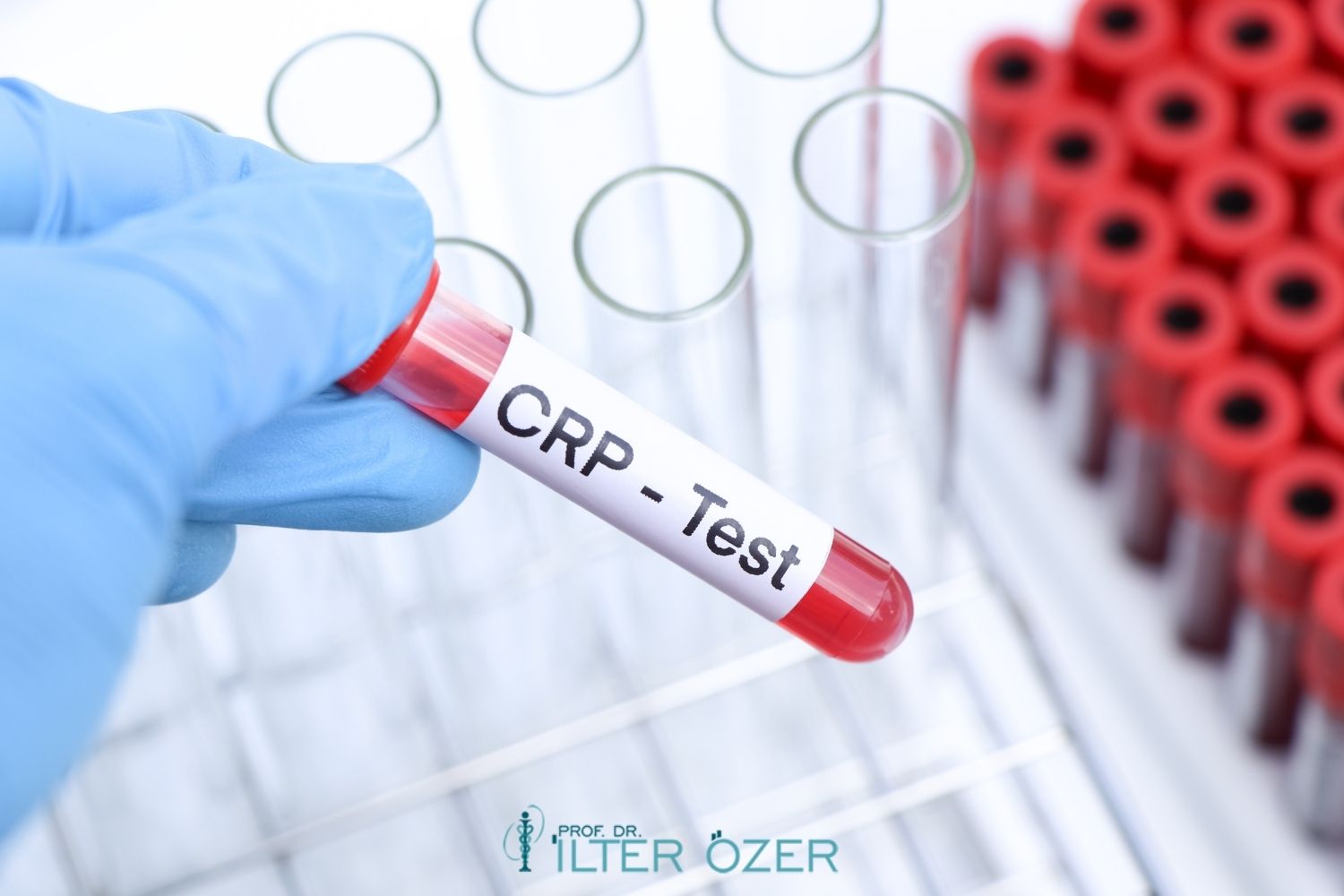 CRP Nedir? CRP Yüksekliği Ne Anlama Gelir?