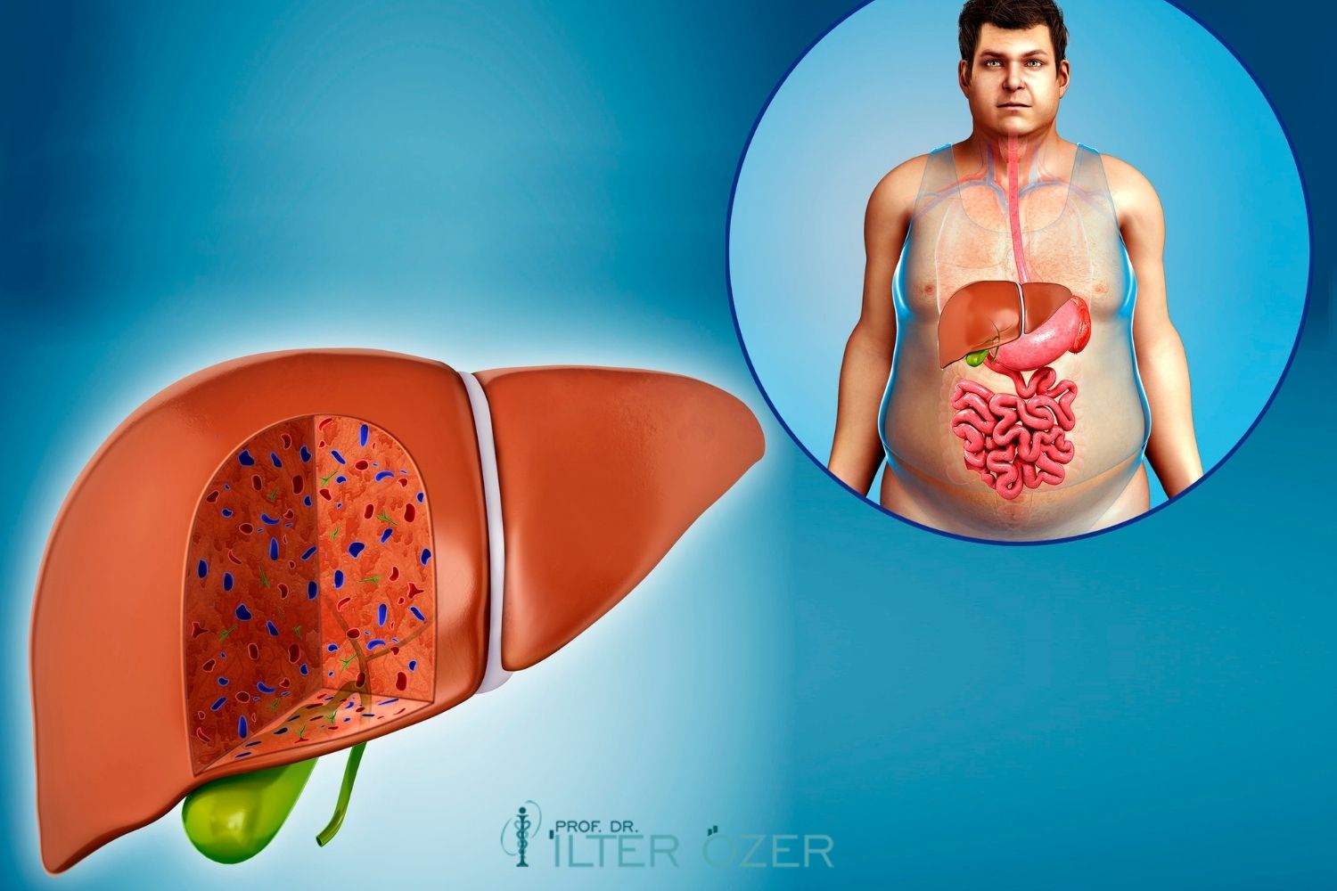 Fatty Liver (Hepatosteatosis)