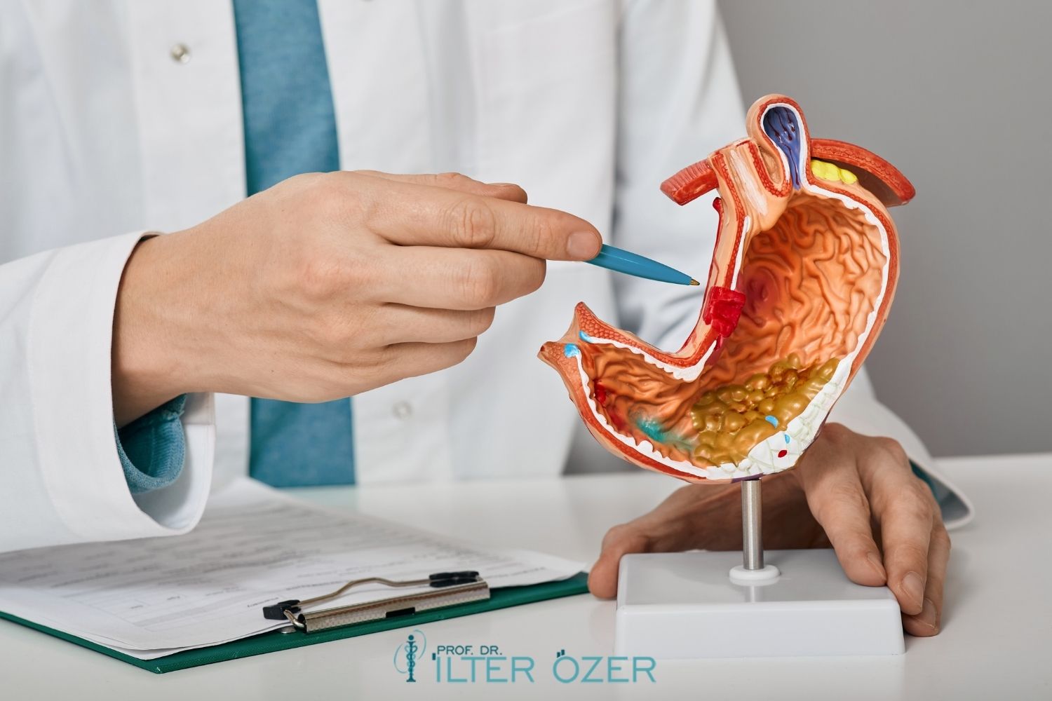 Stage 1 Stomach Cancer