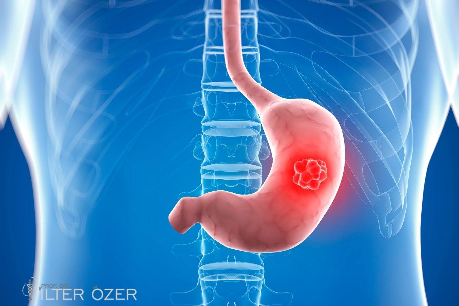 Stage 4 Stomach Cancer Symptoms