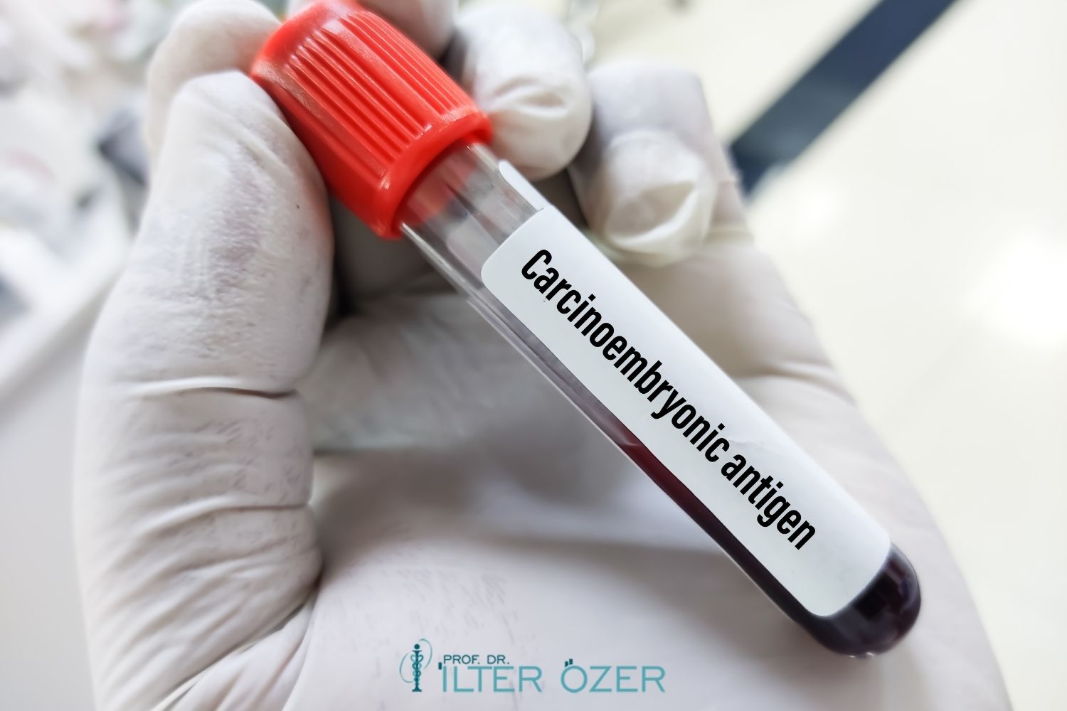 Carcinoembryonic Antigen (CEA)