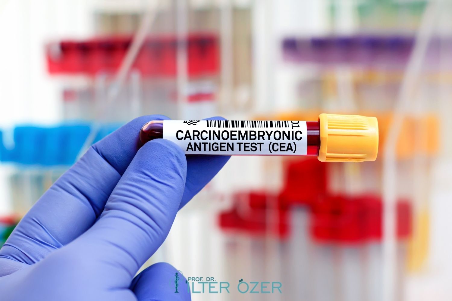 What Does High CEA Mean?