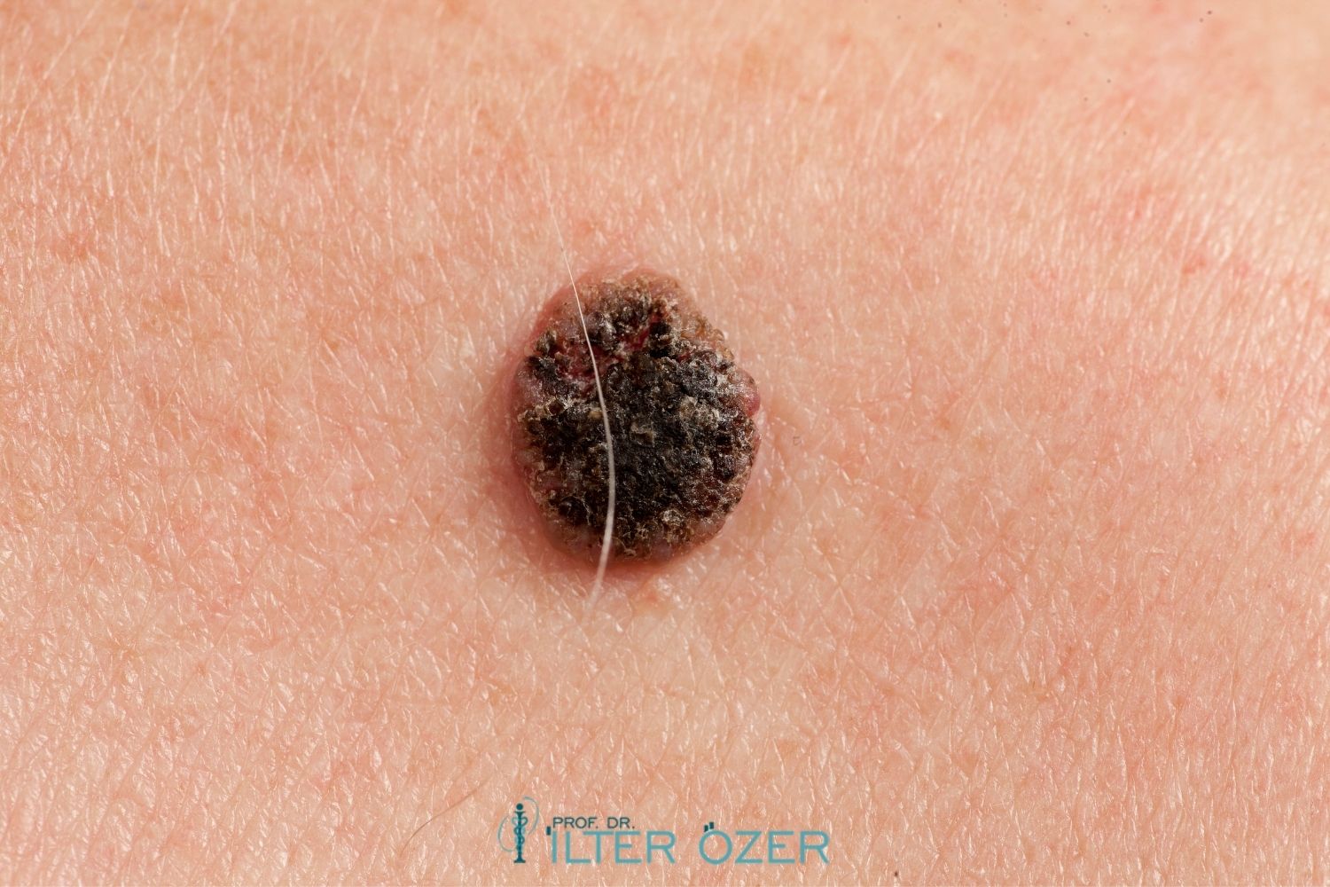 What Is Carcinoma Metastasis? What Are the Treatments?