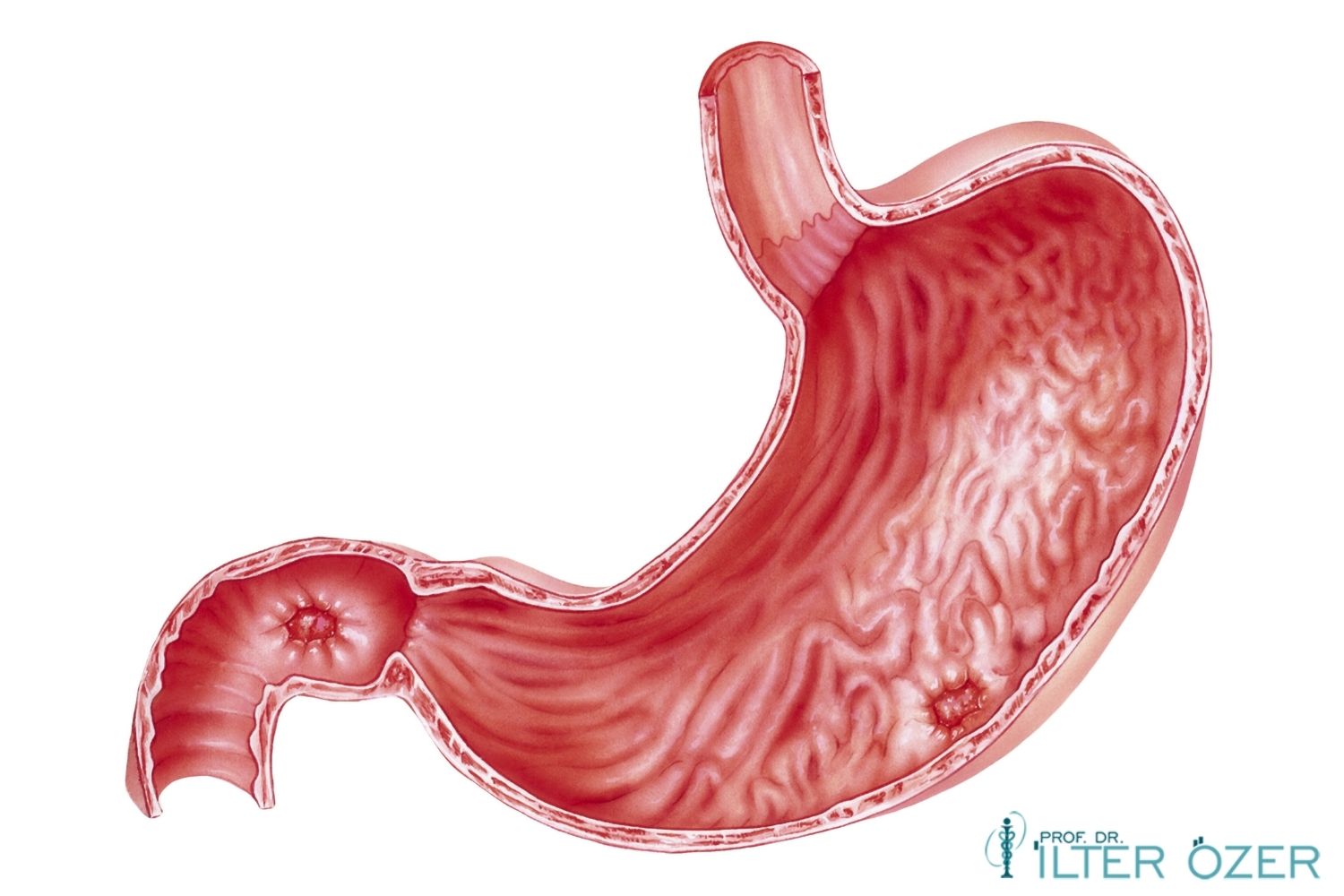 Does Stomach Bleeding Cause Death?