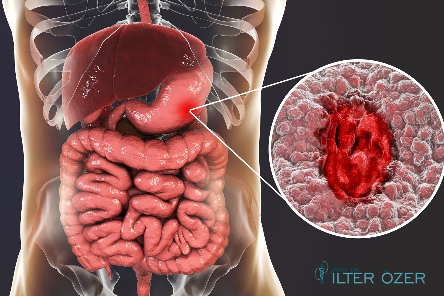 What Is an Ulcer (Stomach Sore)? What Helps with Ulcers?