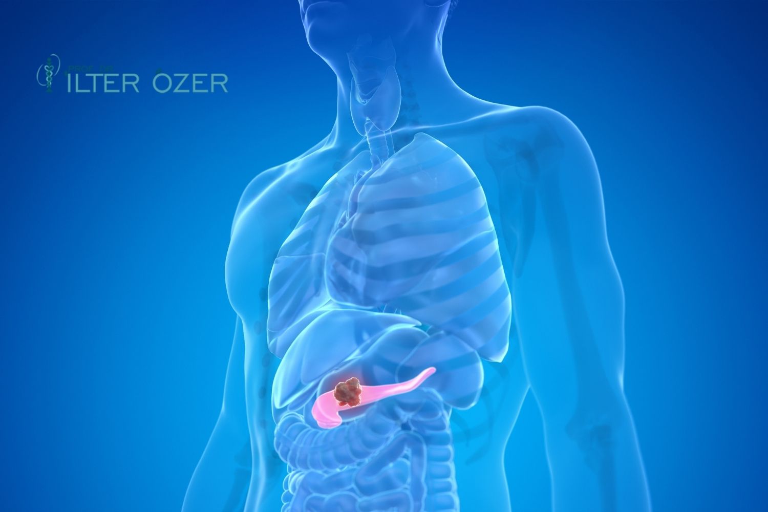 What Is Chronic Pancreatitis? Symptoms and Treatment