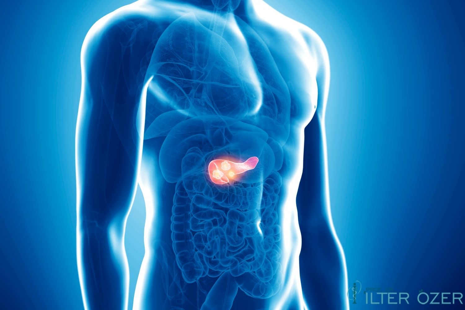 Jaundice in Pancreatic Cancer