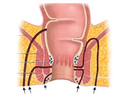 Anal Fistül Nedir? Belirtileri ve Tedavisi