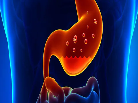 Hiatal Herni ve Gastroözofageal Reflü Hastalığı