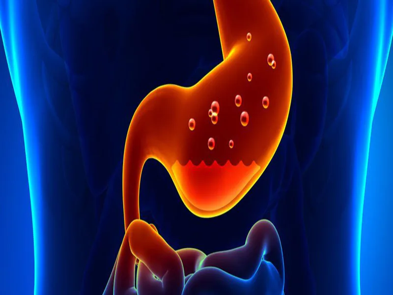 Hiatal Herni ve Gastroözofageal Reflü Hastalığı