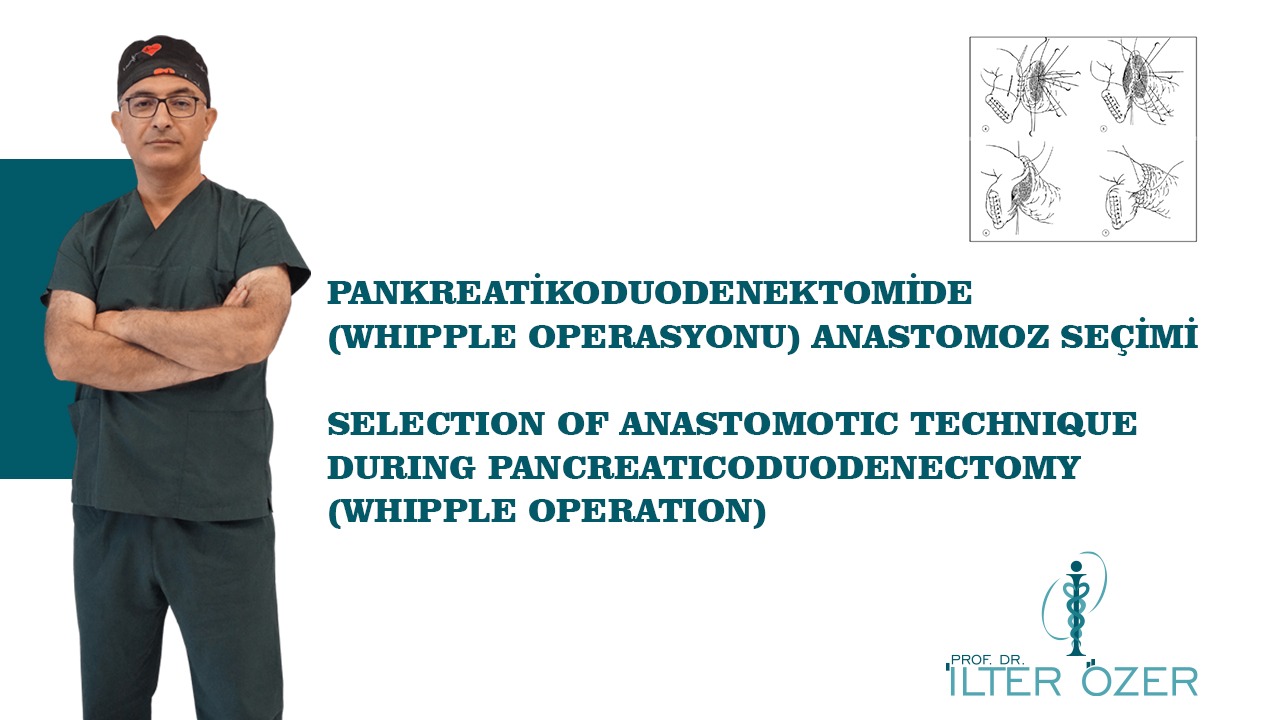 Selection of Anastomotic Technique During Pancreaticoduodenectomy (Whipple Operation)